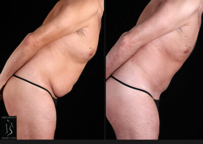 Male Tummy Tuck - Before & After Photos