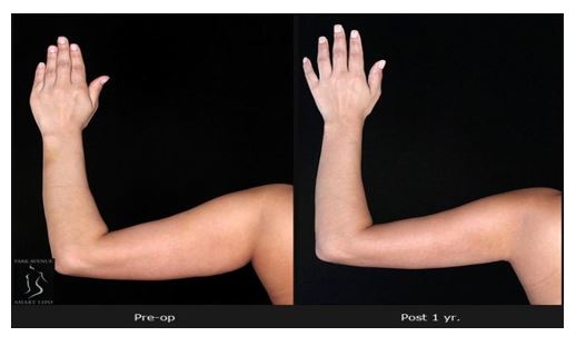 Arm Liposuction - Before and After photo 