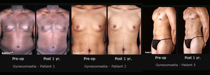 Gynecomastia