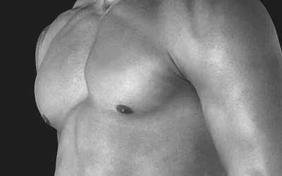 What Makes Gynecomastia Treatment in NYC Stand Out?