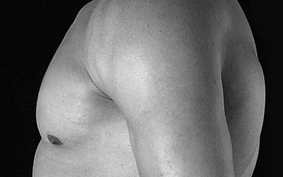 What Causes Gynecomastia? What Is The Best Way To Address The Condition?